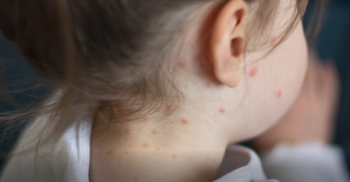 ABC news depiction of a child with measles
